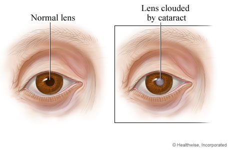 катаракта причины профилактика